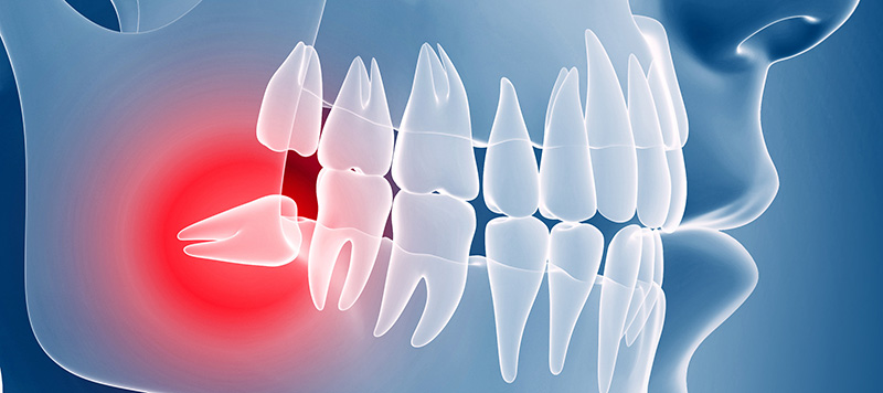 هزینه کشیدن دندان عقل نهفته و نمایان سال ۹۹ دندانپزشکی هروی